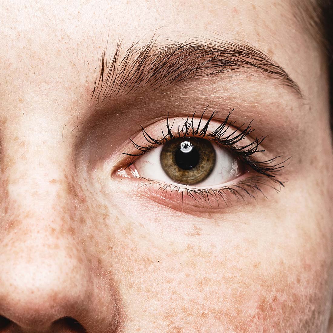 пигментные под глазами. пигментация вокруг глаз. мелазма пигментные пятна. морщины на щеках под глазами. пигментация под глазами.